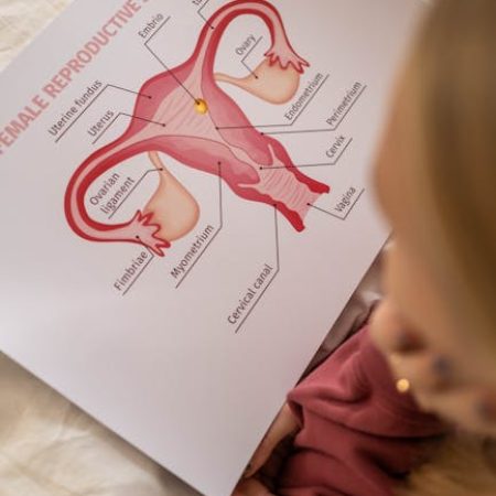 polycystic ovarian syndrome